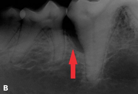 Canine tooth with vertical bone loss.
